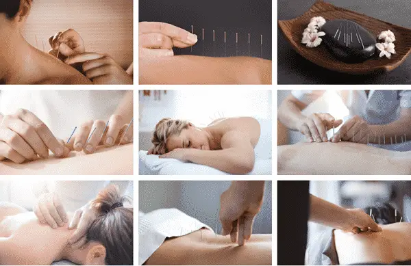 Hints and Tips For Finding a Great Acupuncturist in Fort Lauderdale